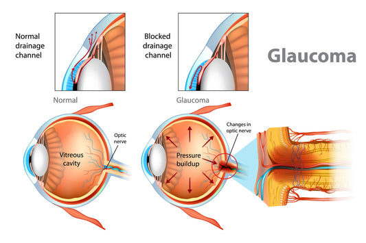 Understanding Open-Angle Glaucoma: Why Regular Eye Exams Matter